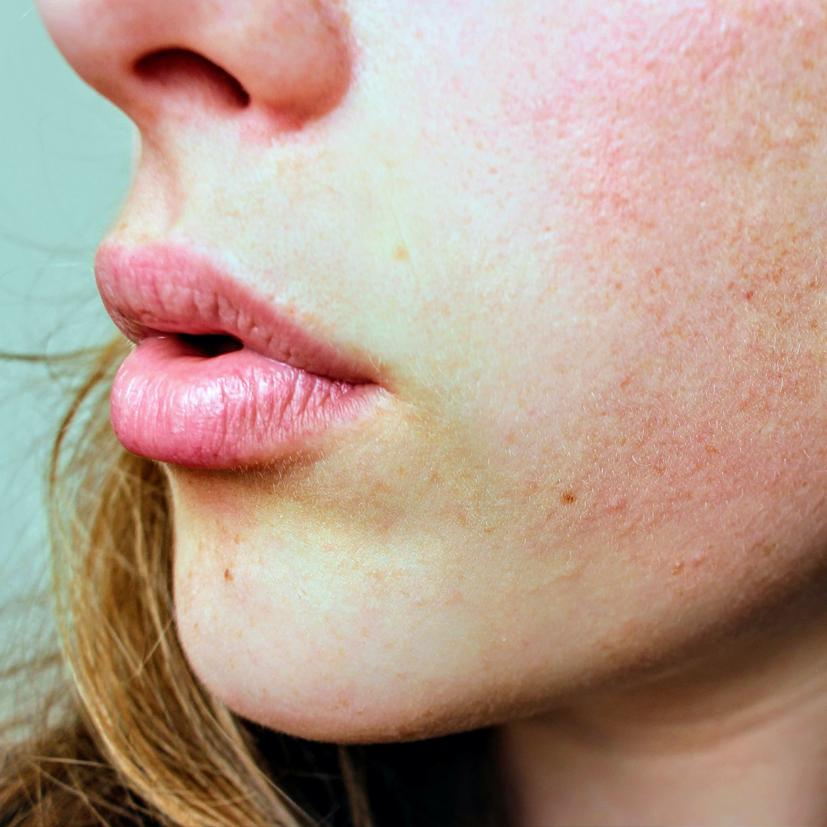Kan makeup gøre min akne hud værre, så jeg får endnu bumser? – Organicmake